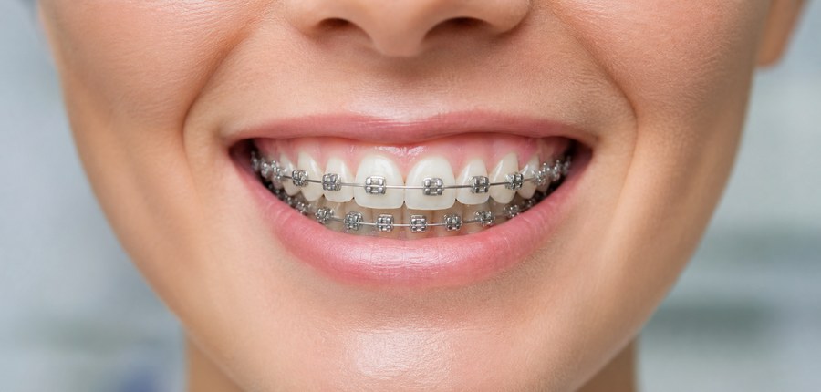 Metal braces treatment